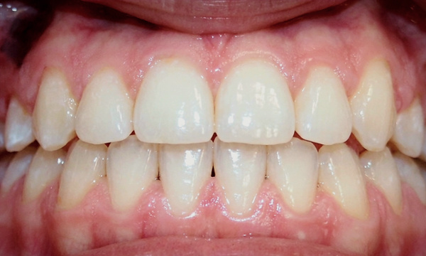 Properly aligned teen smile with corrected impacted canine and closed gaps after metal braces by Kendall Orthodontist.