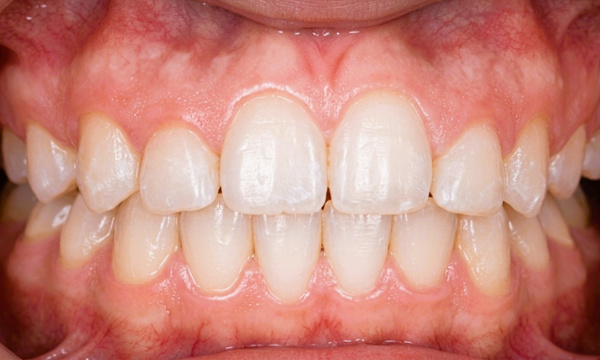 Corrected alignment and straight smile after traditional braces for a teen patient in Kendall.