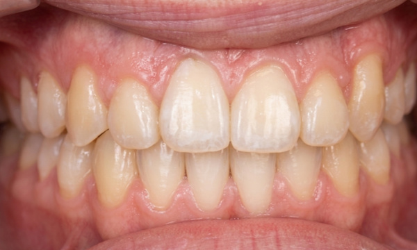 Beautifully aligned smile with the previously hidden eyetooth guided perfectly into place after adult braces in Kendall.
