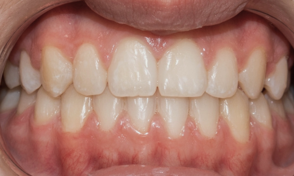  Final smile after 24 months of comprehensive orthodontic treatment with RPE and traditional braces by Dr. Martinez in Kendall.