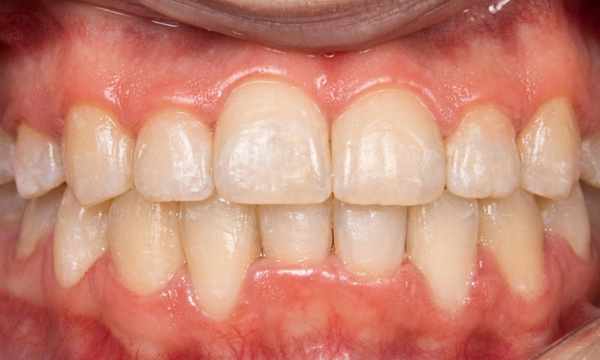 Close-up of the same student showing beautifully aligned teeth achieved without extractions.