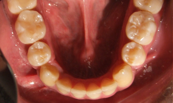 Complete resolution of lower dental crowding and arch expansion, showing perfect alignment by Dr. Martinez in Kendall.