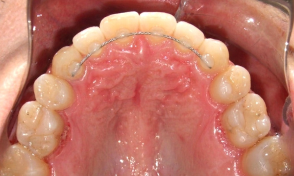 Intraoral occlusal view showing a successfully expanded maxillary arch with a permanent fixed retainer and a stable, aligned dental arch after adult RPE treatment in Kendall.