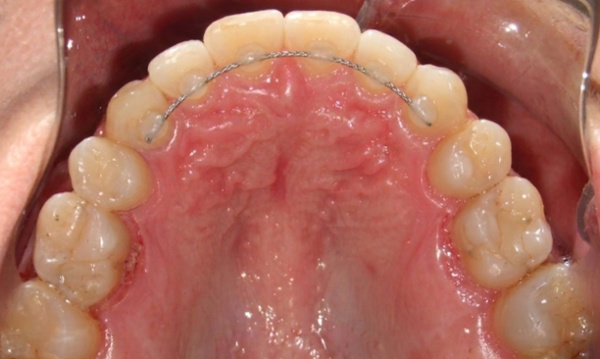 Intraoral occlusal view showing a successfully expanded maxillary arch with a permanent fixed retainer and a stable, aligned dental arch after adult RPE treatment in Kendall.