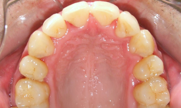  Intraoral occlusal view of a fully aligned maxillary arch post-treatment, displaying proper arch form and ideal tooth positioning.