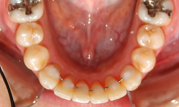 Aligned lower teeth with permanent retainer: Specialized Miami orthodontics.