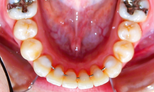 Aligned lower teeth with permanent retainer: Specialized Miami orthodontics.