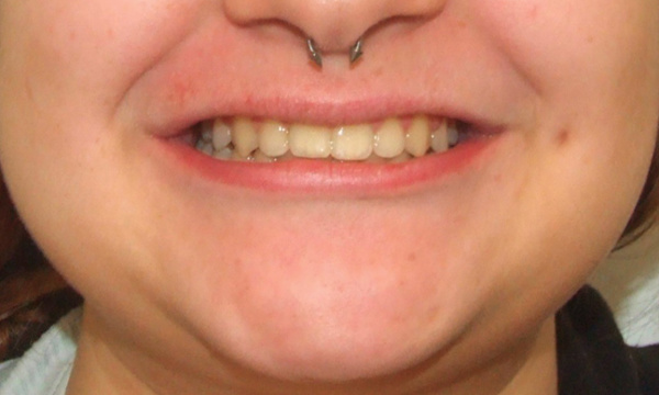 Patient portrait after successful Herbst appliance orthodontic treatment in Miami.