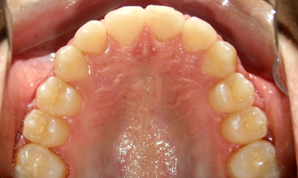 Corrected crossbite and aligned upper arch after comprehensive orthodontic treatment in Miami.