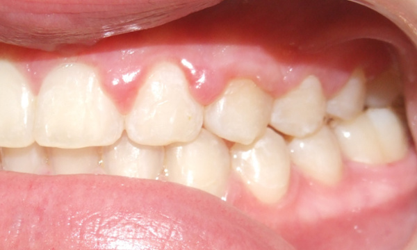 Corrected posterior bite alignment and stabilized occlusion following orthodontic expansion in Kendall.