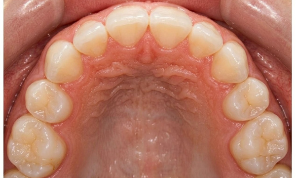 Intraoral view showing successfully aligned canines and resolved crowding after metal braces with extractions in Kendall