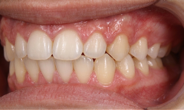 Lateral intraoral view demonstrating corrected bite alignment and ideal overjet following specialized orthodontic care in Kendall.