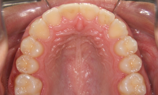 Occlusal view showing an expanded palate and a fully aligned dental arch after 30 months of RPE and braces treatment in Kendall.