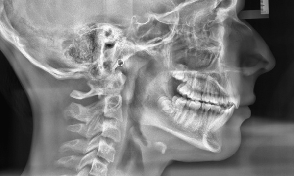 Post-treatment cephalometric radiograph showing improved mandibular projection and skeletal balance in Kendall.