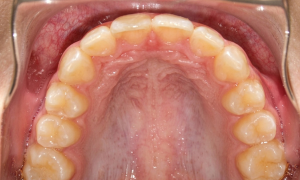 Occlusal view showing an expanded palate and aligned dental arch after 30 months of RPE and braces treatment in Kendall.