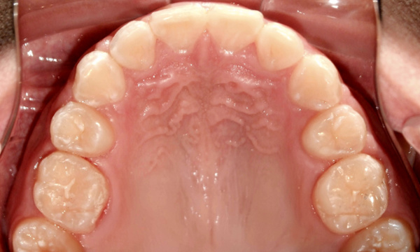 Final orthodontic result showing corrected dental alignment and successful arch development following Palatal Expansion & braces at Martinez Orthodontics Miami.