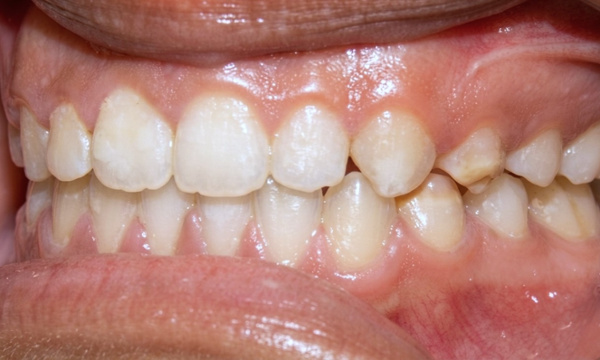 Close up view of a healthy and straight smile after traditional braces treatment in Kendall.