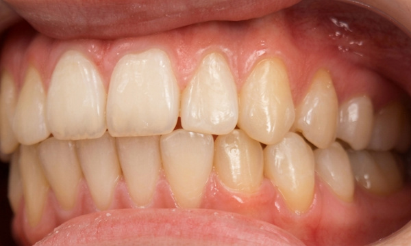 Intraoral side view showing a successfully aligned lower canine and closed posterior bite after metal braces in Kendall