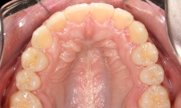 Top-down view showing a perfectly shaped upper arch with all teeth correctly positioned after expert orthodontic care in Kendall.