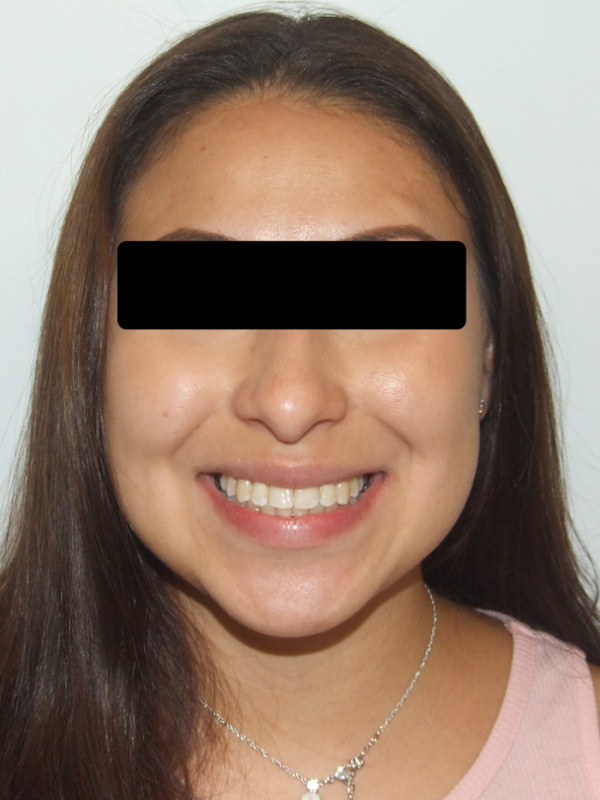 Full smile transformation after braces: Martinez Orthodontics Miami.