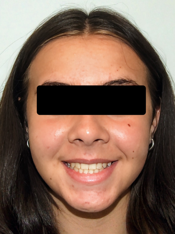  After braces treatment by Kendall orthodontist Dr. Martinez for patient S.P. demonstrating a structurally sound and beautifully balanced smile.