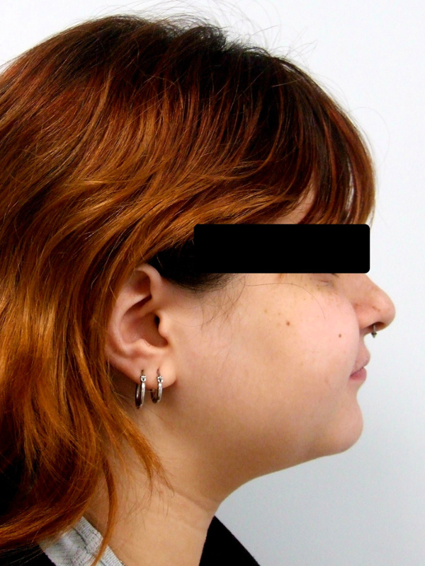 Improved facial profile and corrected overjet after orthodontic treatment in Miami.