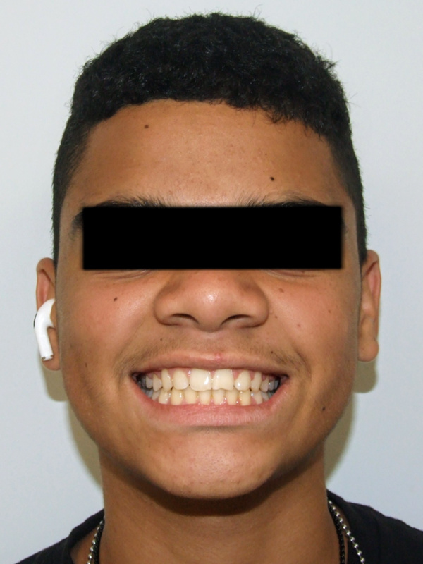 Adolescent patient smiling after 24-month orthodontic treatment in Kendall, Miami.