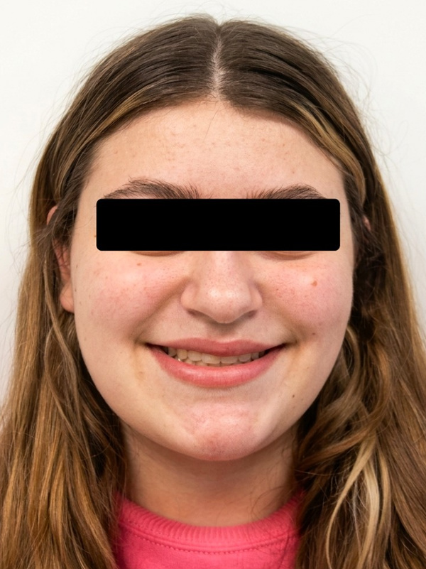 Full-face view showcasing improved facial symmetry and a healthy smile after 30 months of treatment in Kendall.