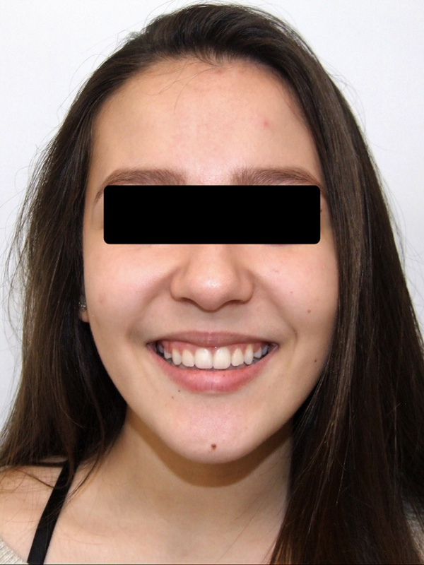 Smiling teen portrait with beautifully aligned teeth and centered midlines after metal braces in Kendall