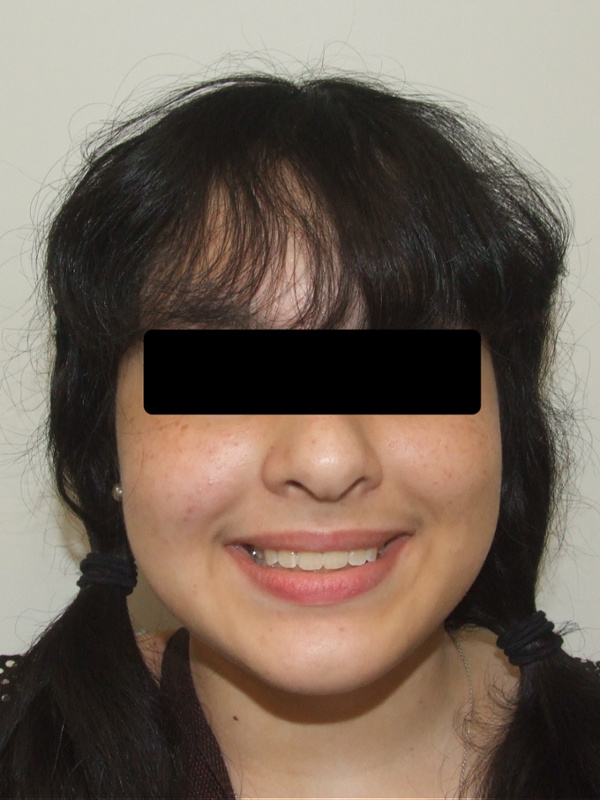 Full-face view showcasing improved facial harmony and a corrected deep bite after 30 months of braces in Kendall.