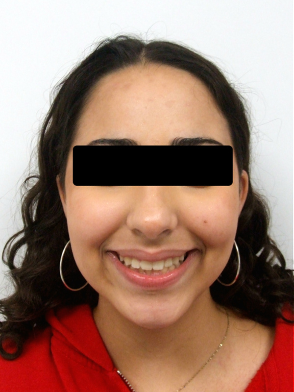 Retrato frontal de paciente preadolescente con una sonrisa amplia y alineada después de 30 meses de tratamiento con frenillos en Kendall.