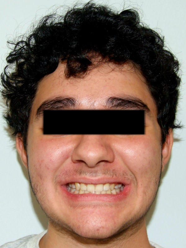 Frontal portrait of a patient displaying an aligned upper canine and functional bite after traditional metal braces treatment in Kendall.