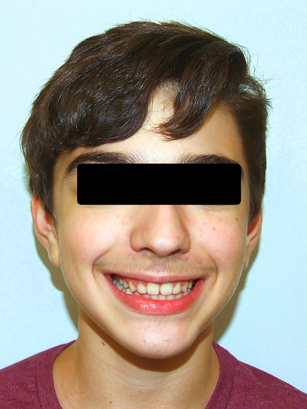 Full-face and profile harmony showing improved jaw projection and a healthy smile in Kendall.