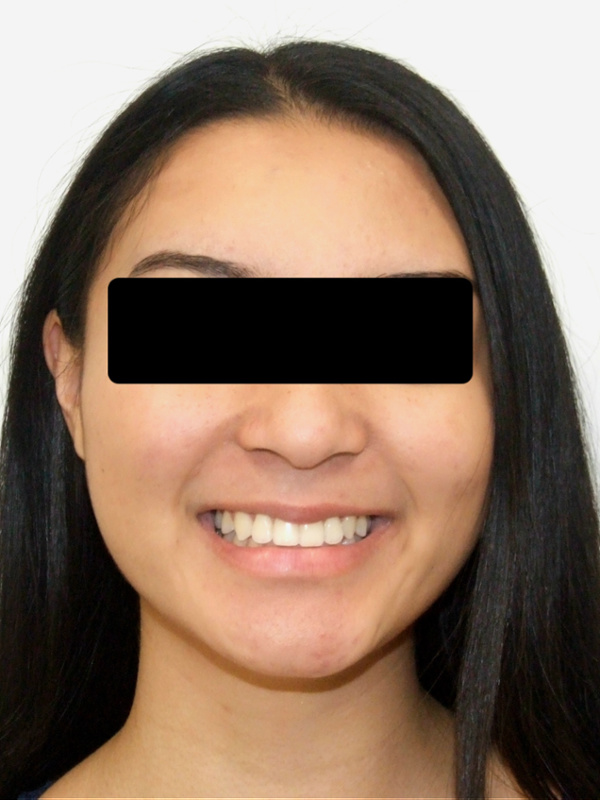 Successful alignment and a healthy smile following specialized orthodontic care in Kendall.