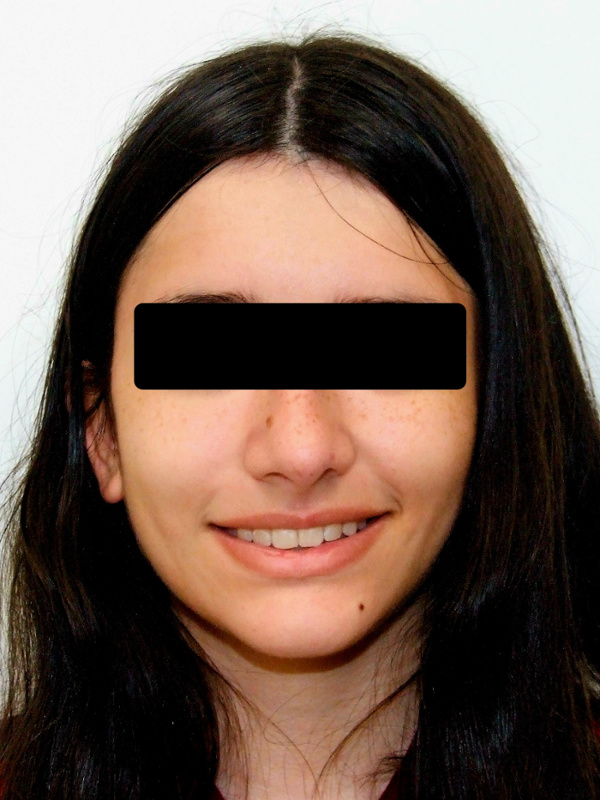 Complete smile transformation portrait after braces at Martinez Orthodontics Miami.
