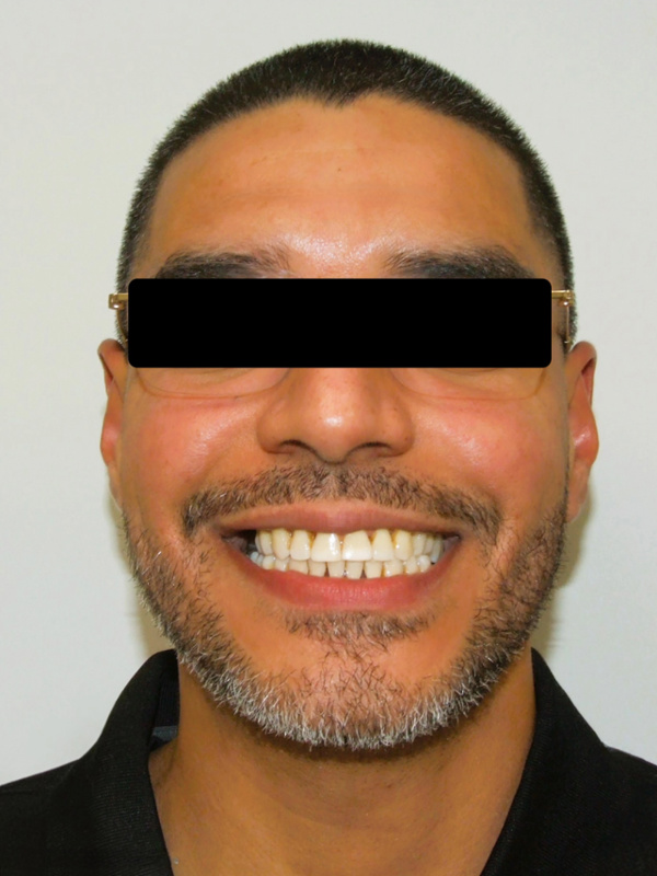 Confident adult patient showcasing a beautifully restored smile following comprehensive multidisciplinary orthodontic therapy in Kendall.