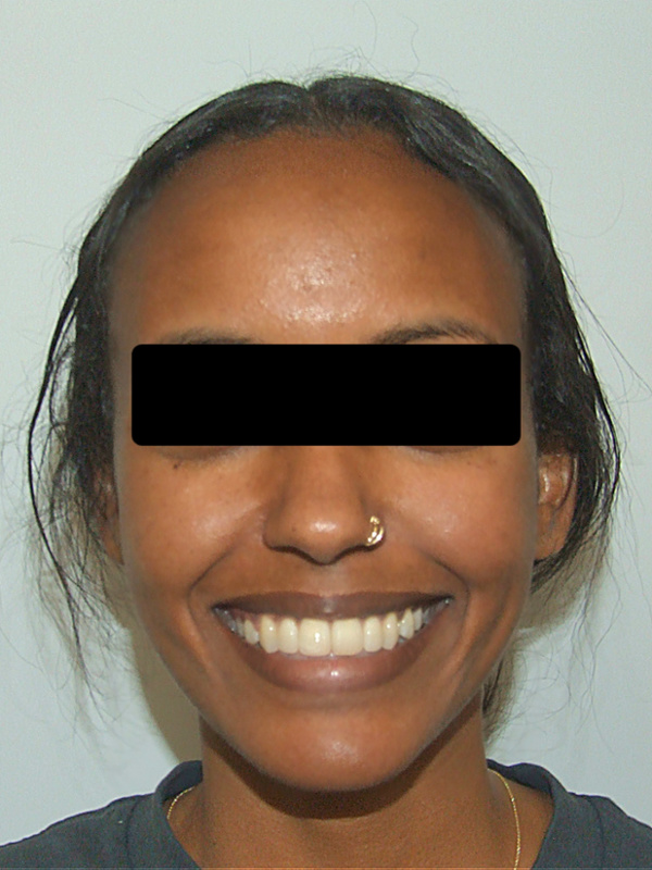 Clinical portrait of the same patient showcasing the successful non-surgical closure of the open bite and a harmonious, aligned smile.
