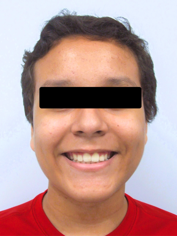 Smiling preteen portrait with a beautifully corrected overjet and safely retracted front teeth after metal braces in Kendall