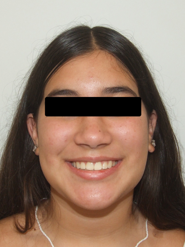 Frontal portrait of a preteen with a broad, healthy smile after 30 months of comprehensive orthodontic treatment in Kendall.