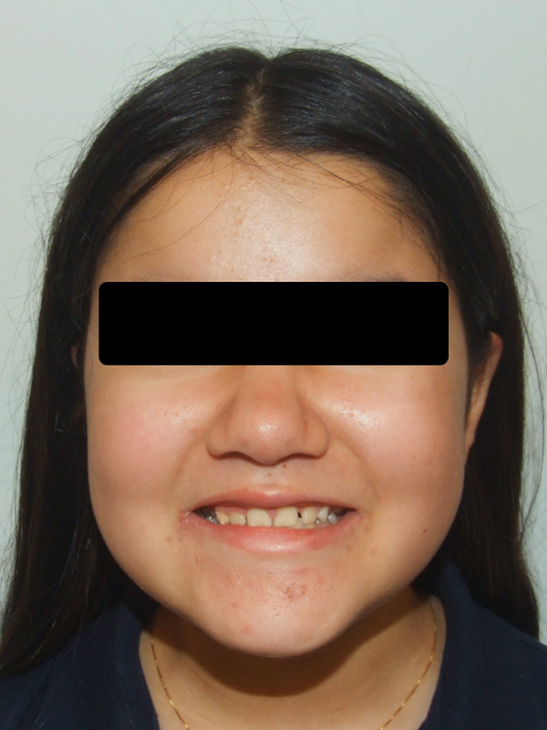 Smiling preteen portrait with a properly corrected underbite after Phase I expander and partial braces in Kendall