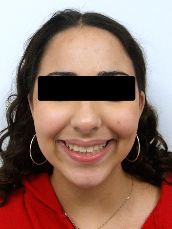 Retrato frontal de paciente preadolescente con una sonrisa amplia y alineada después de 30 meses de tratamiento con frenillos en Kendall.