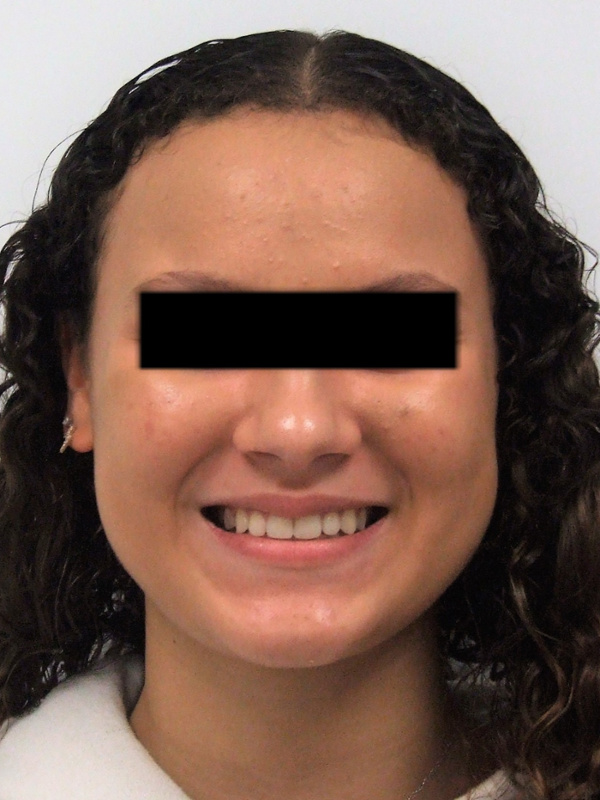 Full-face view showcasing a healthy, balanced smile following 24 months of braces and canine surgery in Kendall.