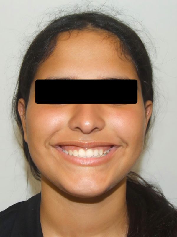 Portrait of a teenager showing a confident and straight smile after braces in Kendall.