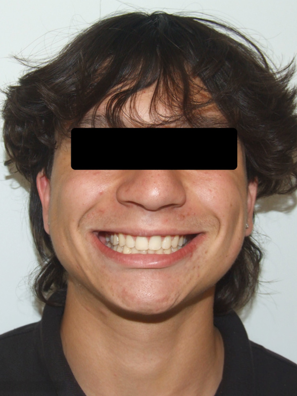 Smiling teen portrait with a balanced jawline and corrected bite after metal braces and Herbst appliance in Kendall.
