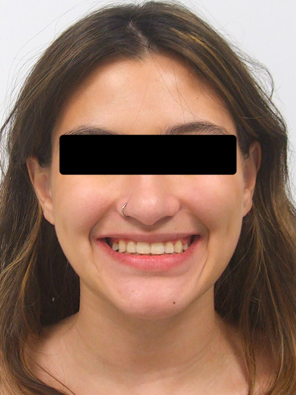 Full clinical portrait of the same student displaying a beautifully aligned smile following non-extraction treatment.