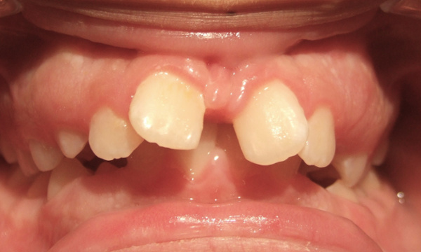 Adolescent patient with severe overjet, impinging overbite, and diastemas before beginning traditional braces at Martinez Orthodontics in Miami.