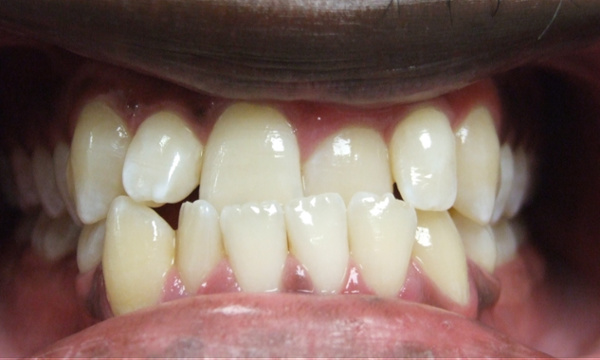Adult Class III patient with severe lower crowding and anterior crossbite before extraction therapy at Martinez Orthodontics Miami.