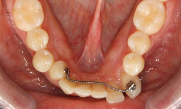 Adult with shifted teeth due to a broken fixed retainer before braces in The Crossings. 