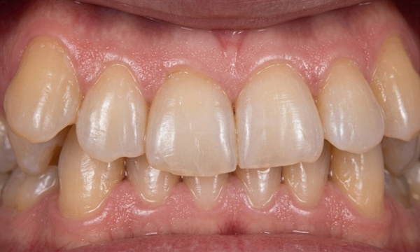 Adult patient with a collapsed maxillary arch, crossbite, and over-retained primary molars before RPE and braces at Martinez Orthodontics Miami.