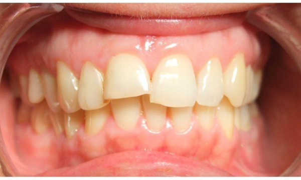 Adult patient with protruding front teeth and shifted midline before metal braces treatment in Kendall.